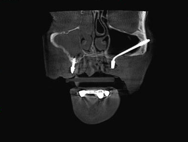 Röntgenbild welche die eingesetzten basalen Implantate zeigt